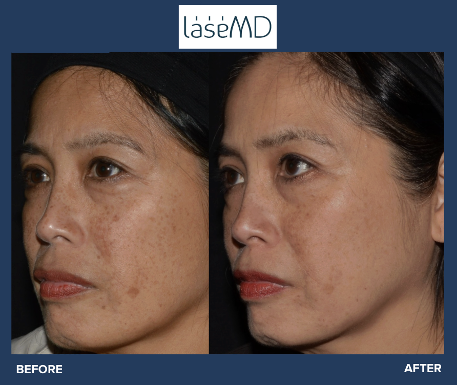 LaseMD Before and After Results