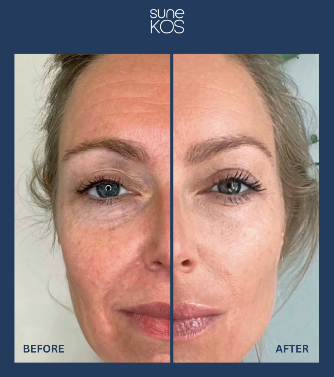 Sunekos Before and After Results