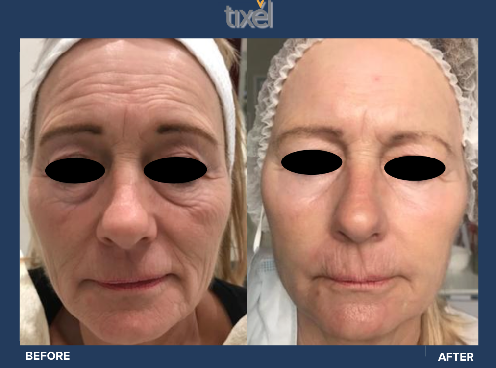 Tixel Before and After Results